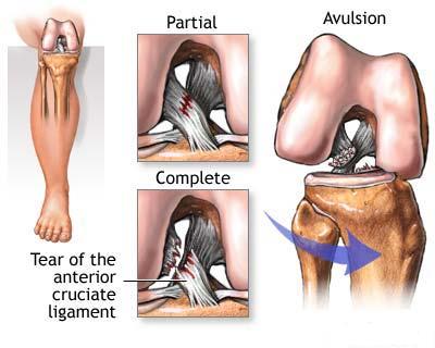 Ligament incrucisat anterior - leziuni 1