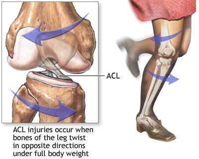 Ligament incrucisat anterior - leziuni 2