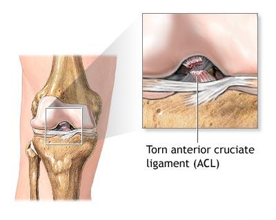 Trat. leziunii de lig. incrucisat anterior - indicatie