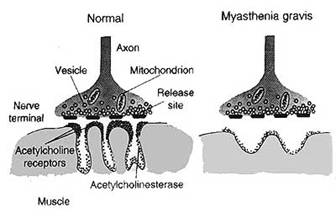 miastenie