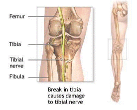 Fractura tibie cu leziune de nerv tibial