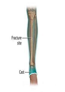 Tratamentul fracturii de tibie - imobilizare aparat gipsat