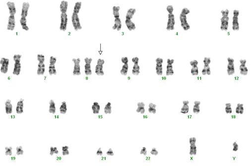 https://imgendiagnostics.com/images/trisomy8.jpg